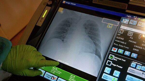 Рентгеновский снимок легких пациента с COVID-19 - Sputnik Latvija